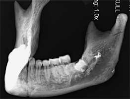 impacted tooth